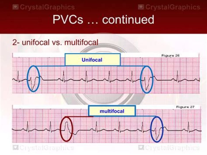 Are unifocal pvcs dangerous?