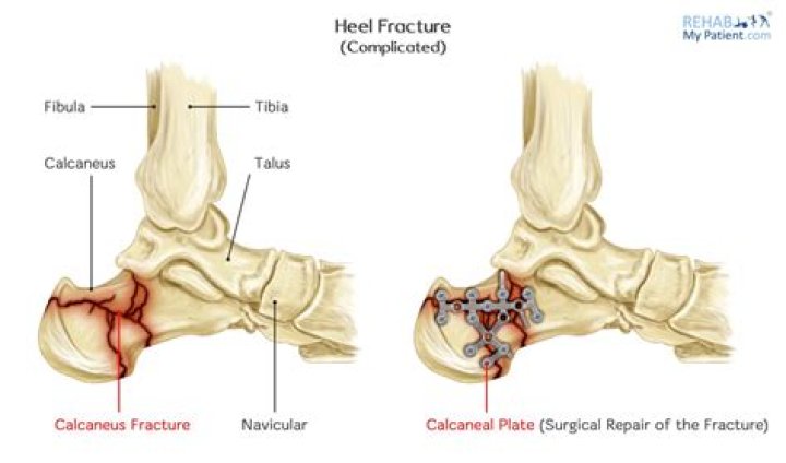 Can you break your heel?