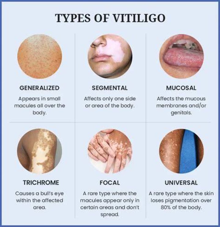 Do vitiligo patches go away?