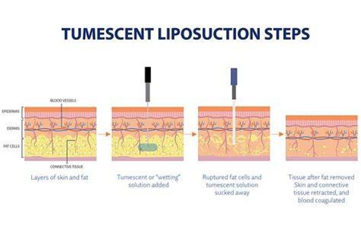 How much is tumescent liposuction?