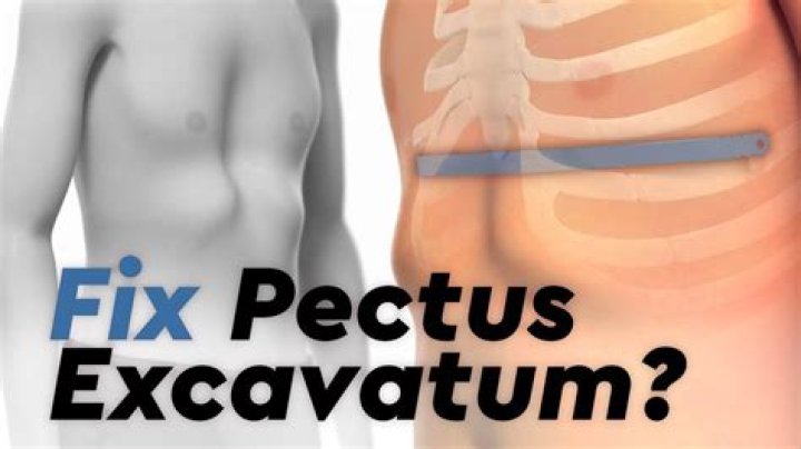 Should i have pectus excavatum surgery?