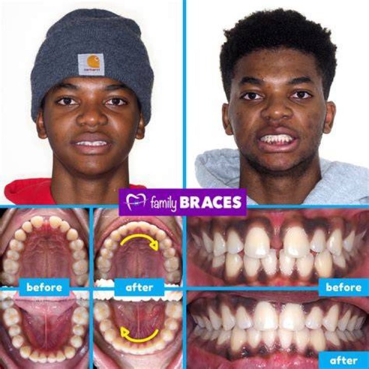 What does the word gap-toothed mean?