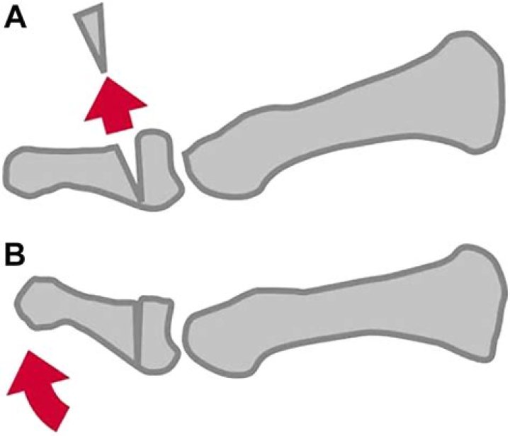 What is a moberg osteotomy?