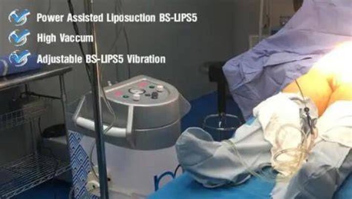 What is suction assisted lipectomy?