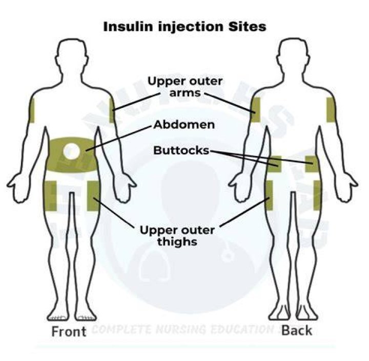 Where are insulin injection sites?