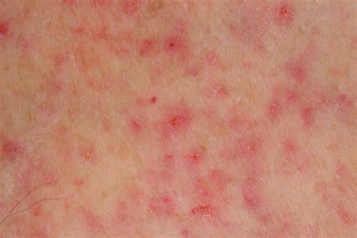Where do skin blotches come from?