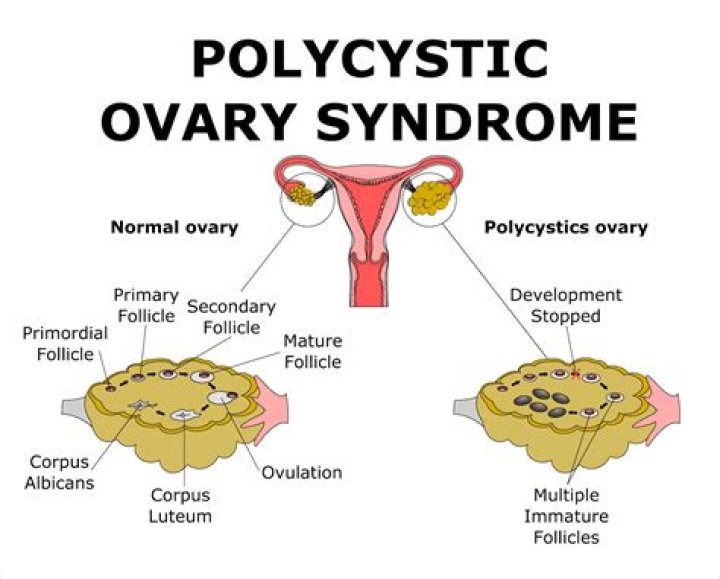 Why does polycystic ovaries cause pain?