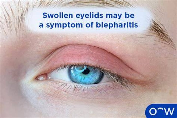 Why won't my blepharitis go away?