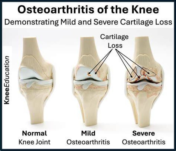 Will osteoarthritis get worse?